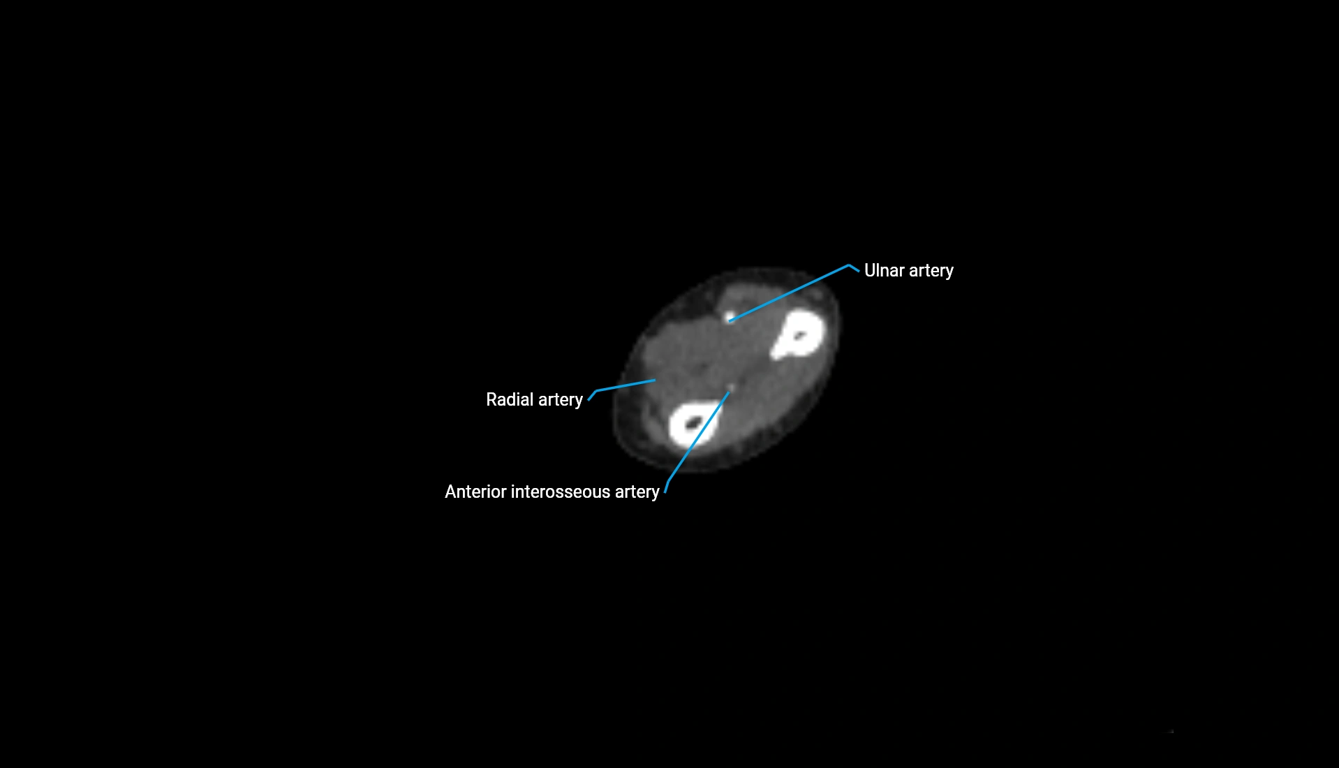 CTA upper limb axial cross sectional anatomy labelled image 121 (2).webp